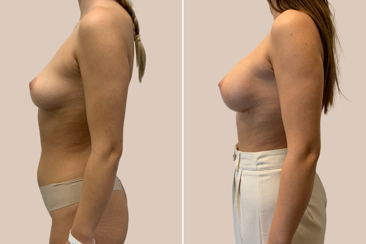 Brystforstørrelse før og efter