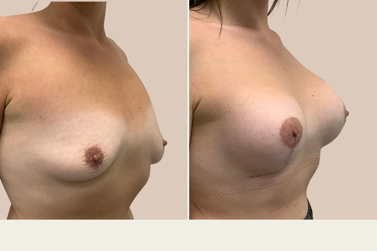 Før og efter BFO og løft