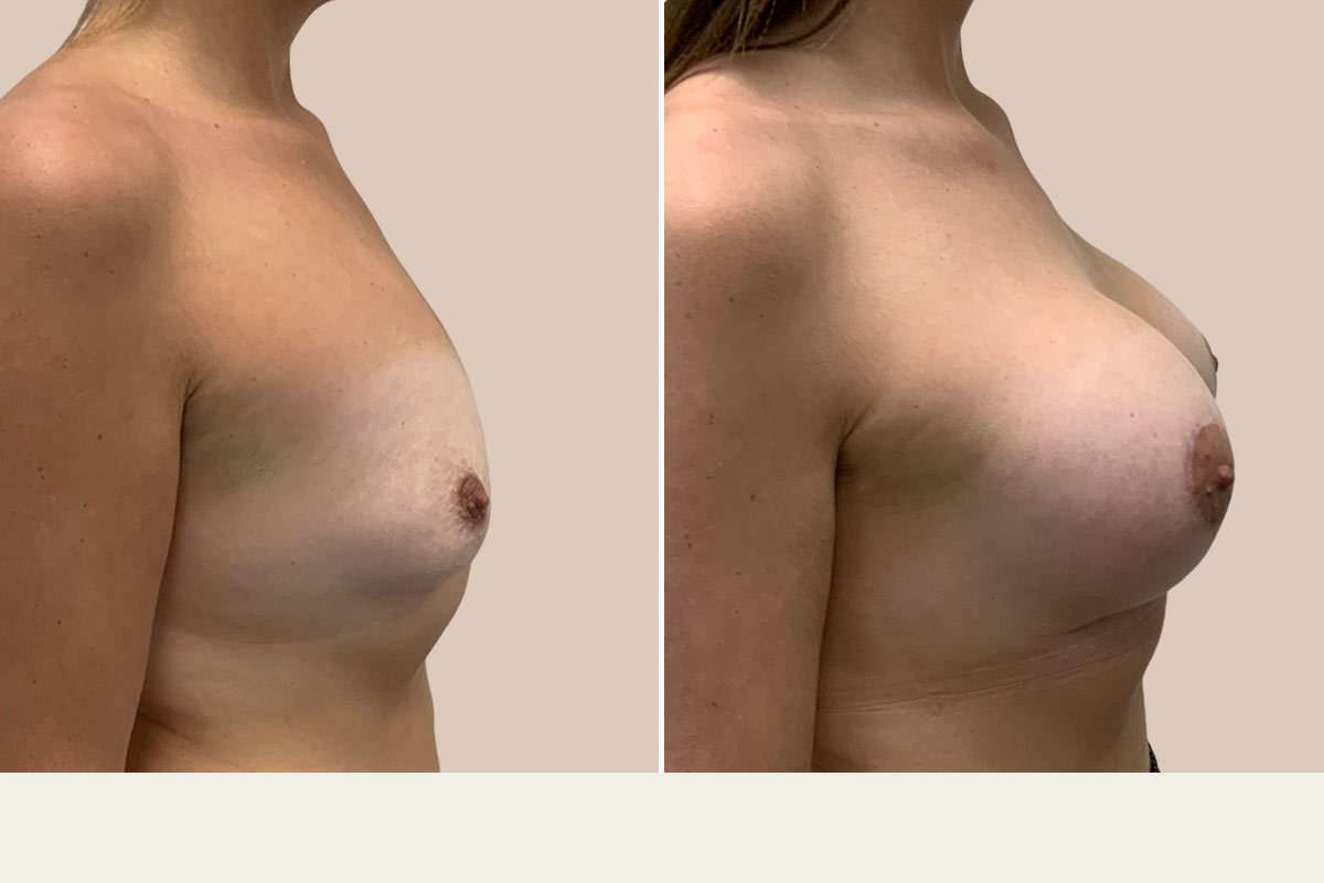 Før og efter BFO og løft