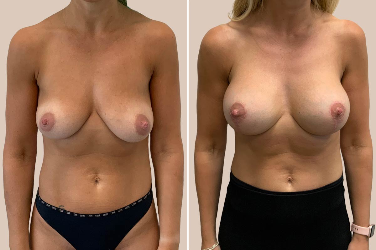 BFO og løft før og efter