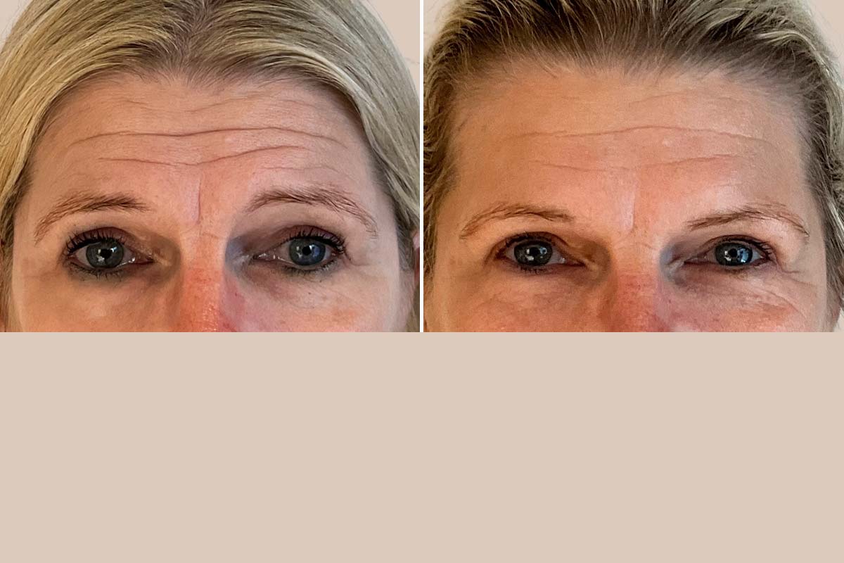 Botox - glabella / bekymringsrynke.