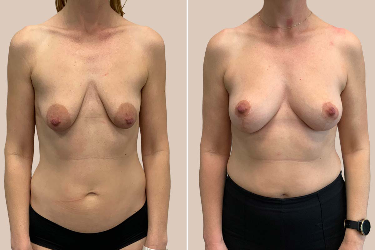 Stort brystløft + fedttransplantation til brystet
