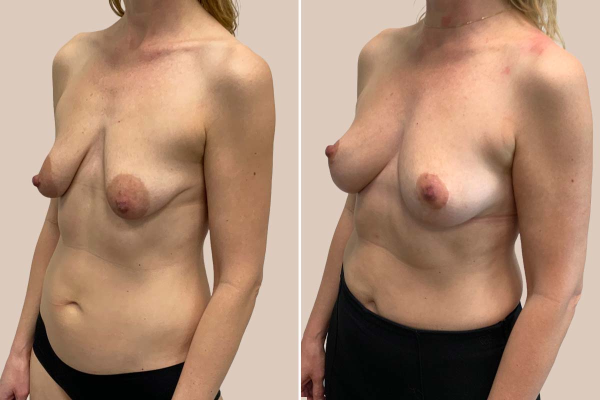 Stort brystløft + fedttransplantation til brystet