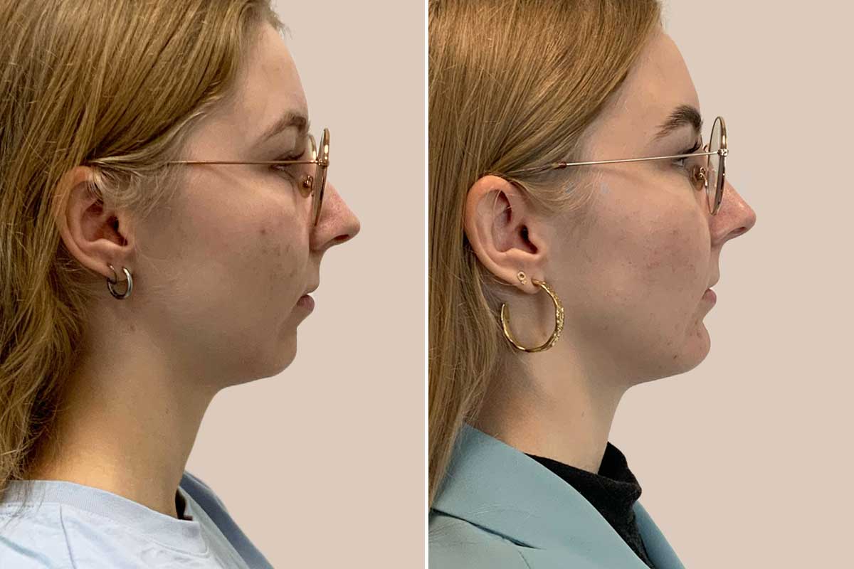 Før og efter hageimplantat