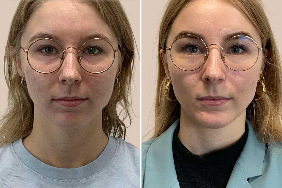 Før og efter hageimplantat