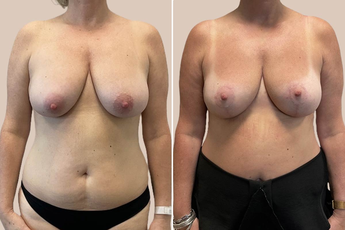 Stort brystløft før og efter