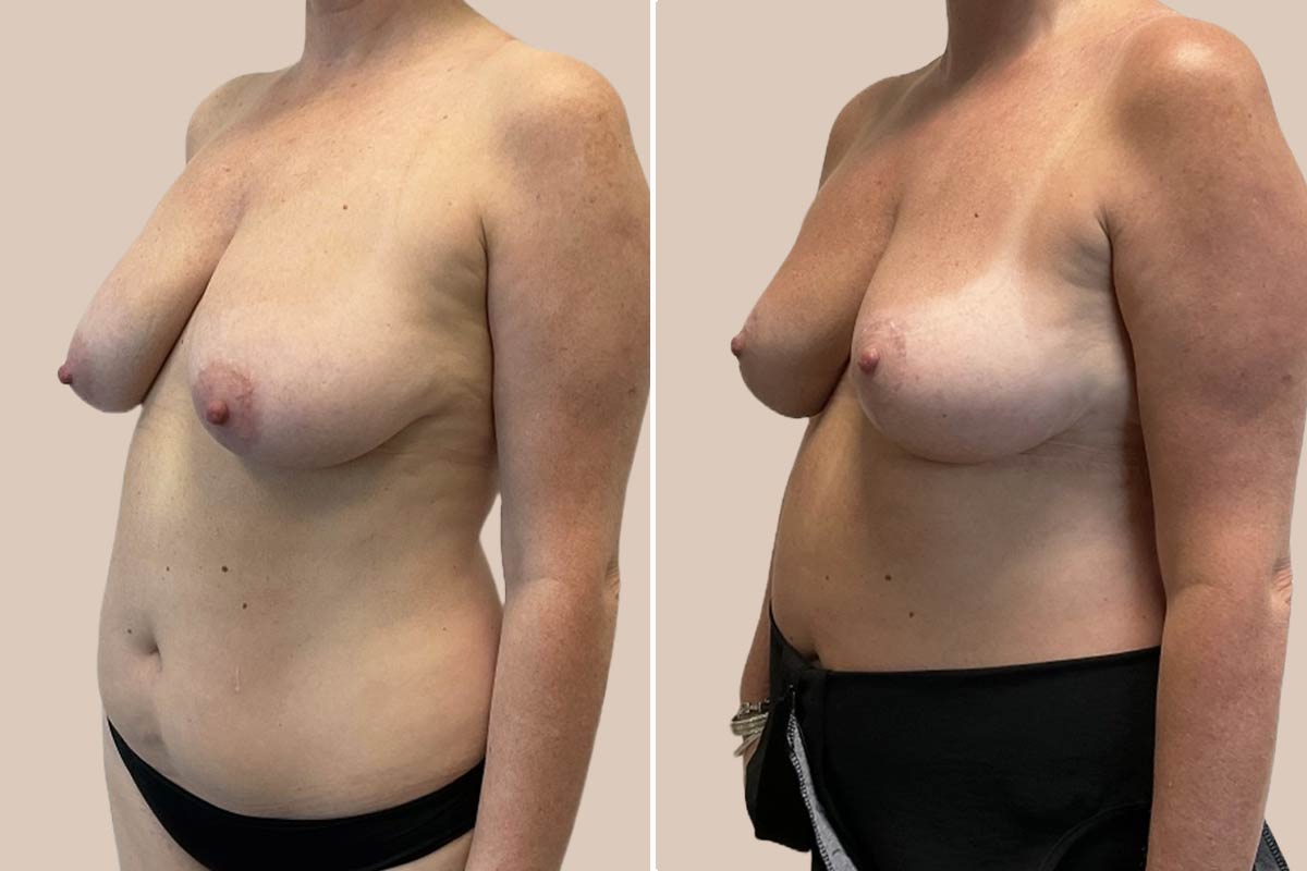 Stort brystløft før og efter