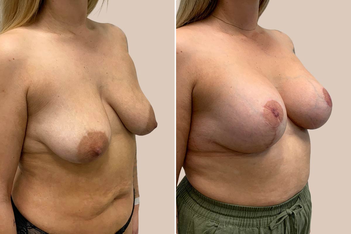 BFO og løft før og efter