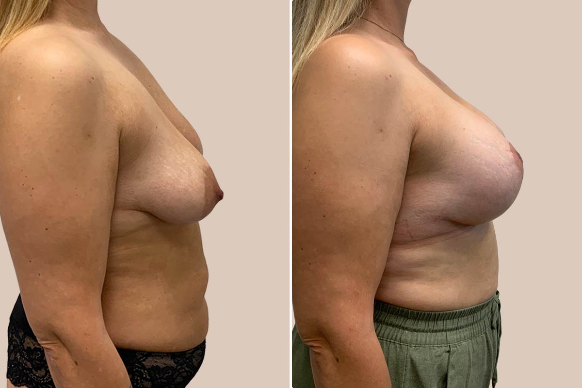 BFO og løft før og efter