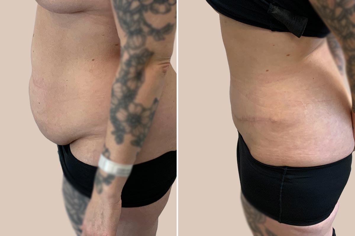 Maveplastik før og efter