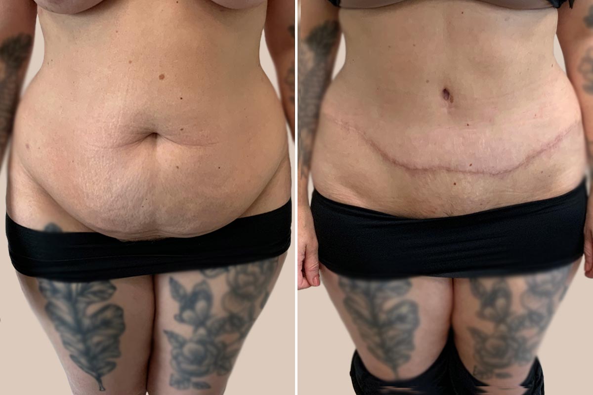 Maveplastik før og efter