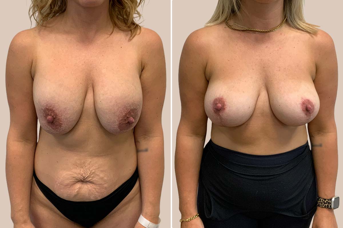 Udskiftning af implantater før og efter