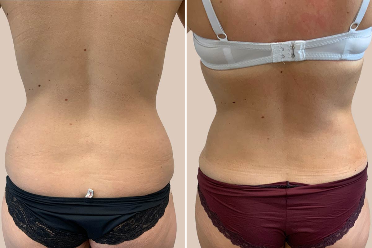 Fedtsugning før og efter