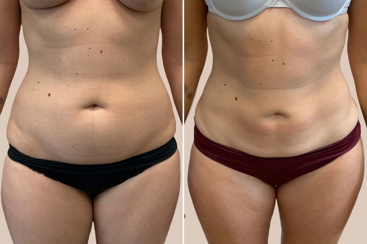 Fedtsugning før og efter