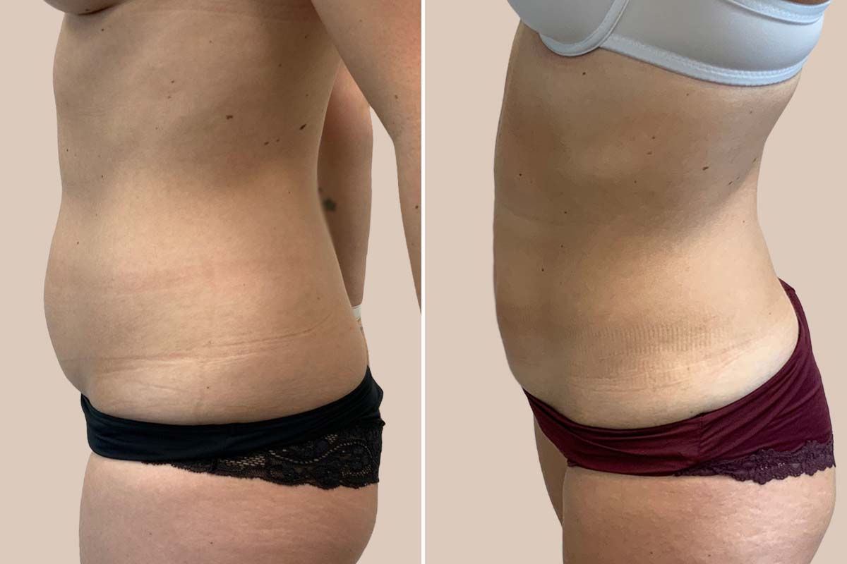 Fedtsugning før og efter