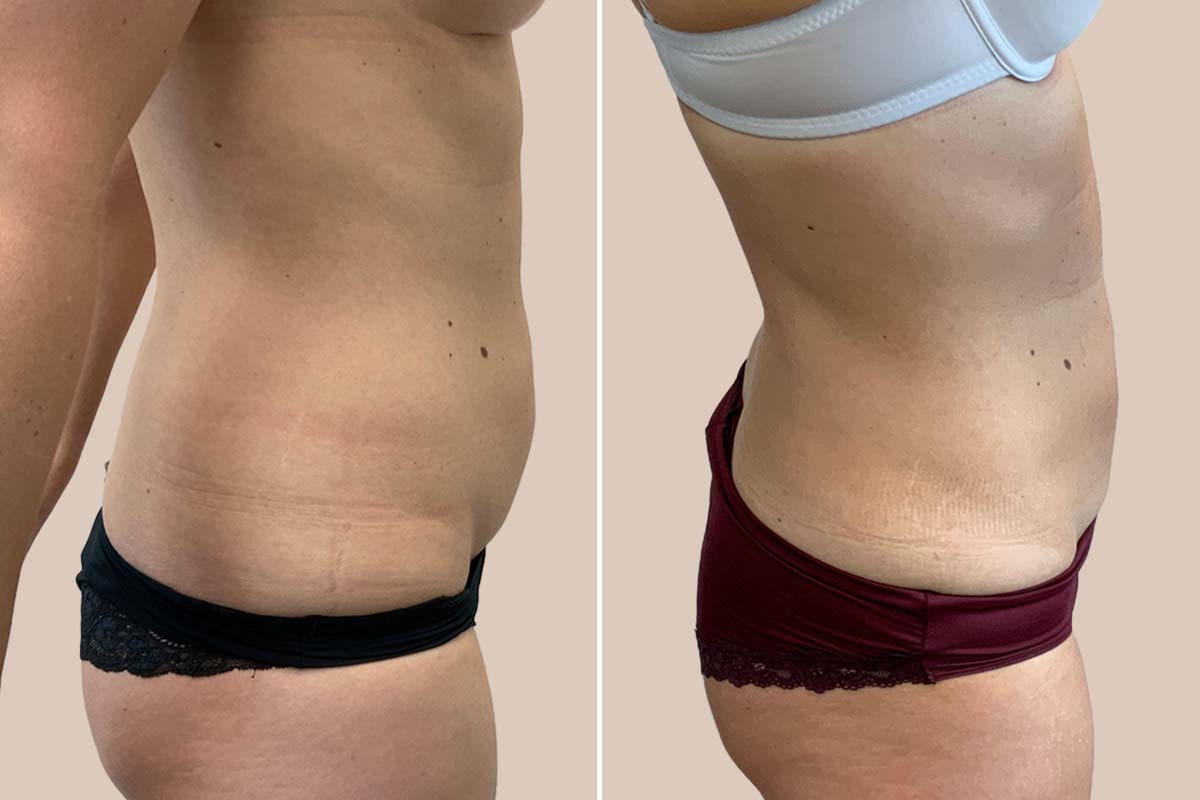 Fedtsugning før og efter