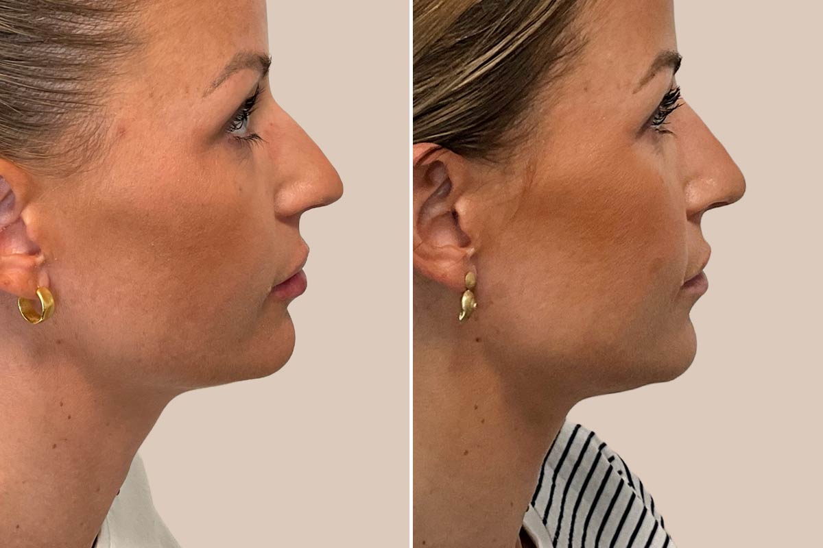 Filler før og efter