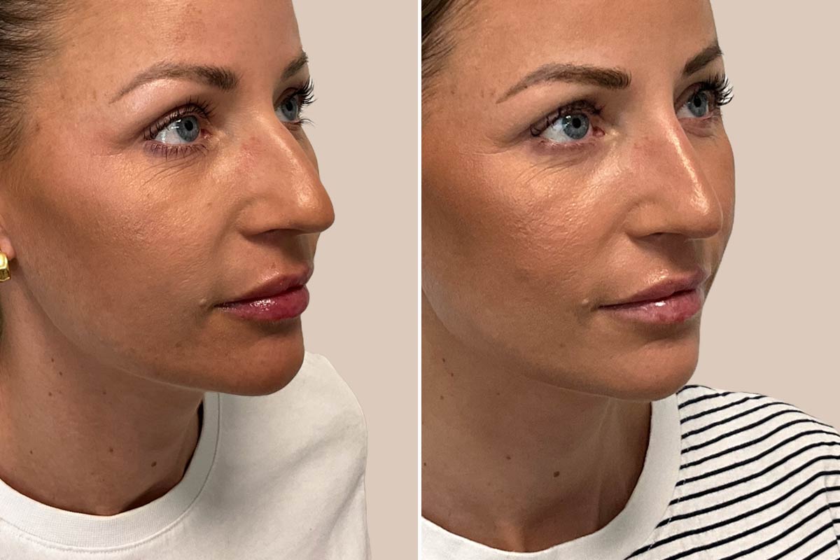 Filler før og efter