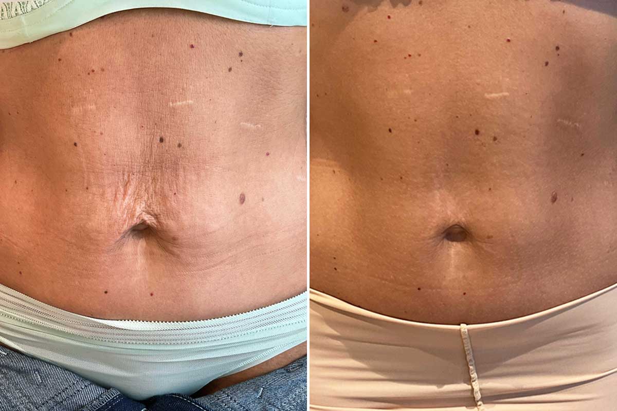 Profhilo behandling før og efter