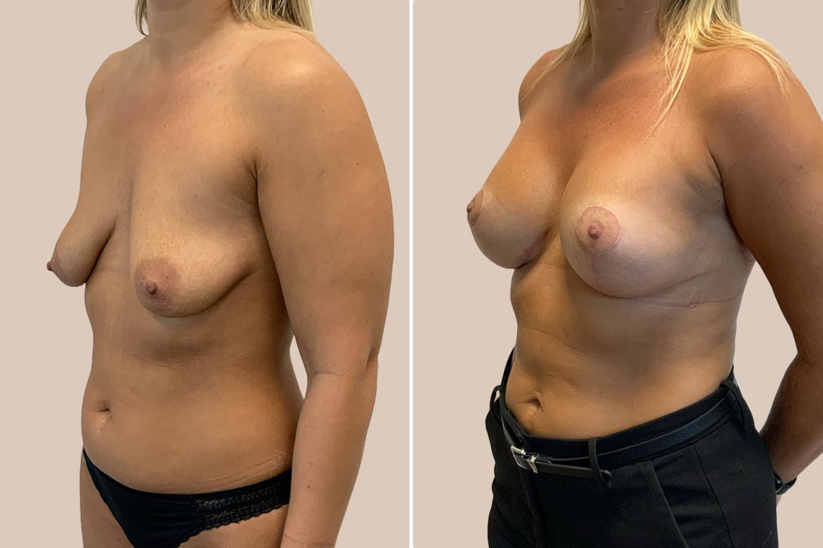 Bfo og løft før og efter