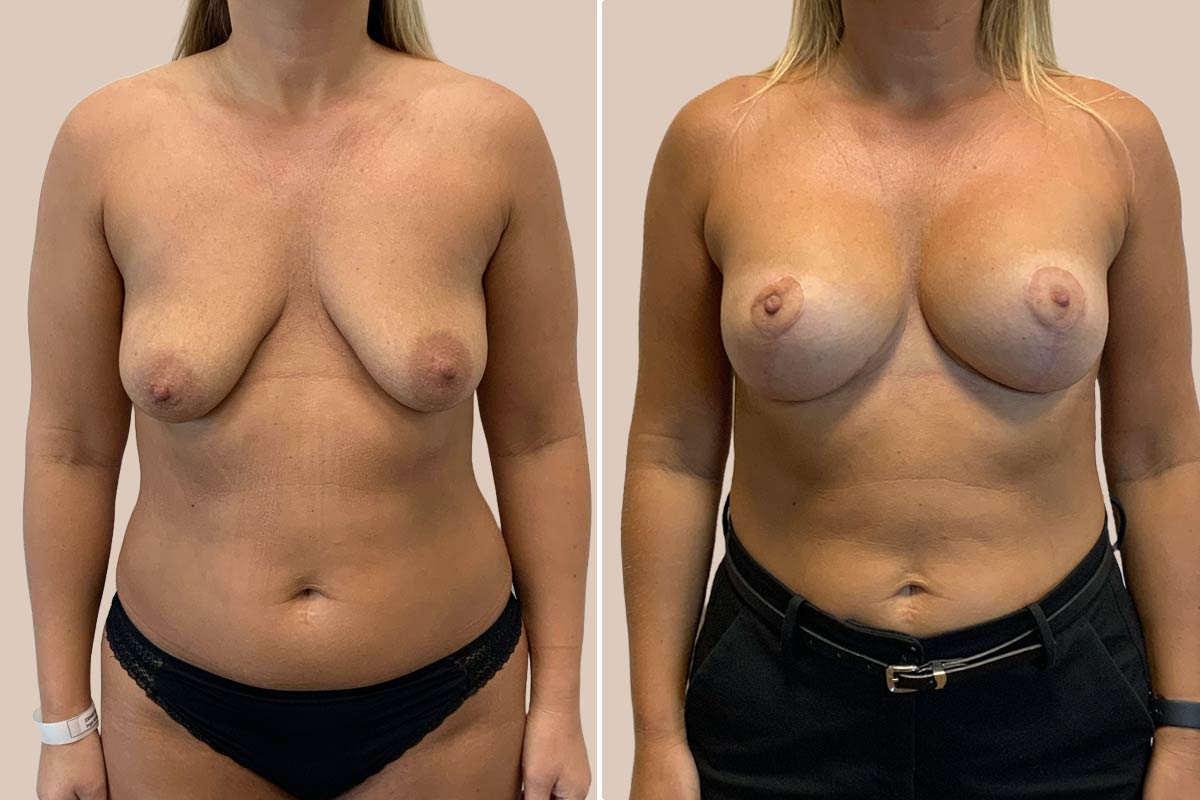 Bfo og løft før og efter