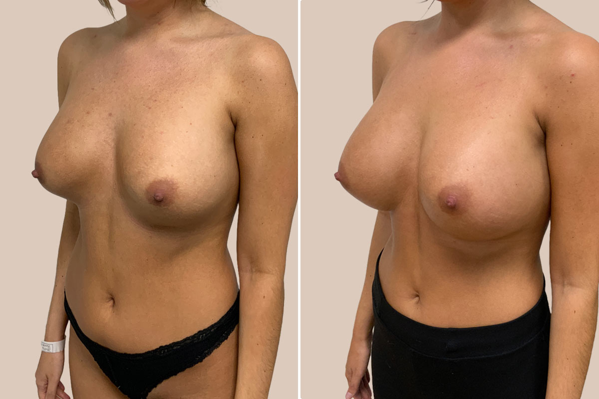 Udskiftning af implantater