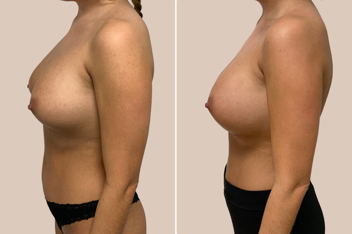 Udskiftning af implantater