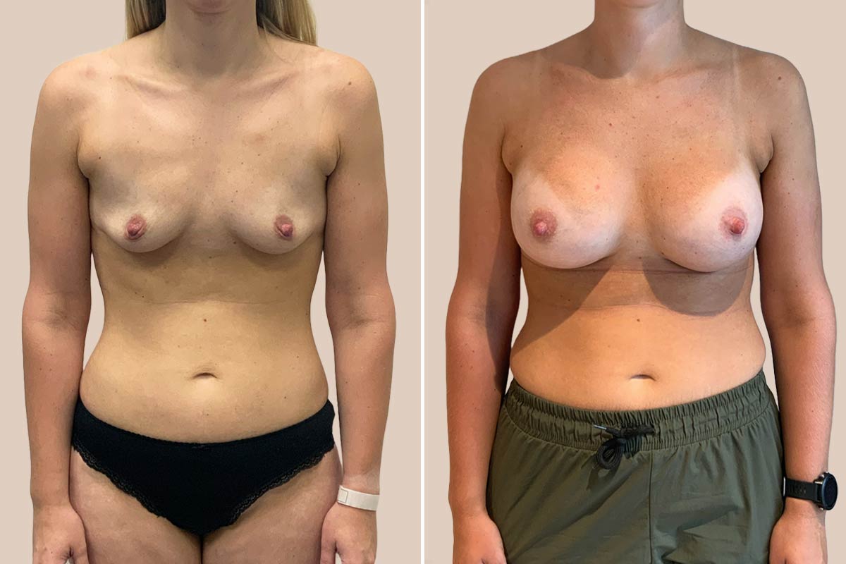 Brystforstørrelse før og efter
