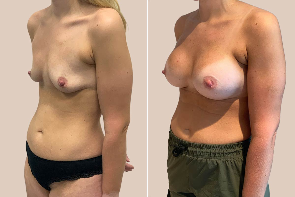 Brystforstørrelse før og efter