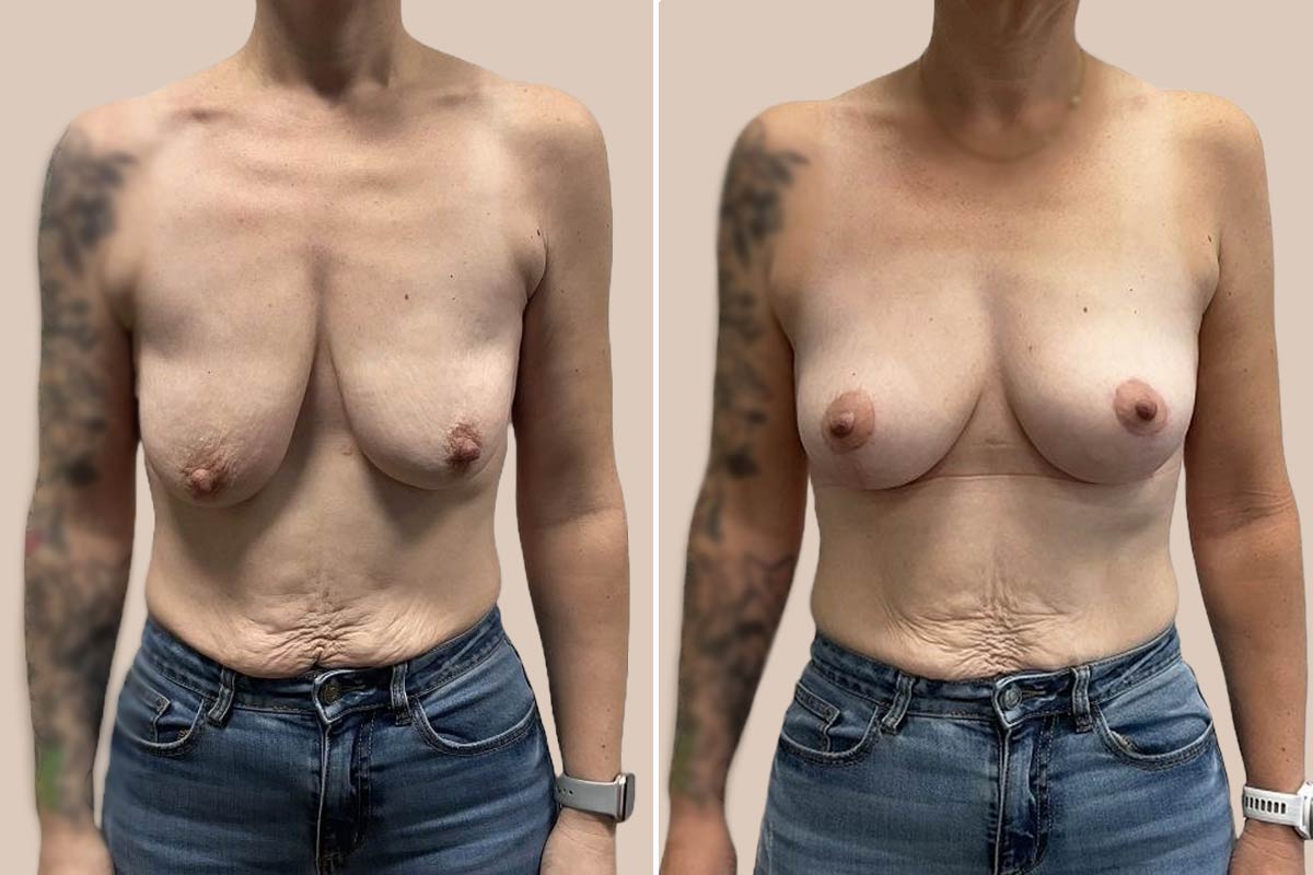 Stort brystløft før og efter