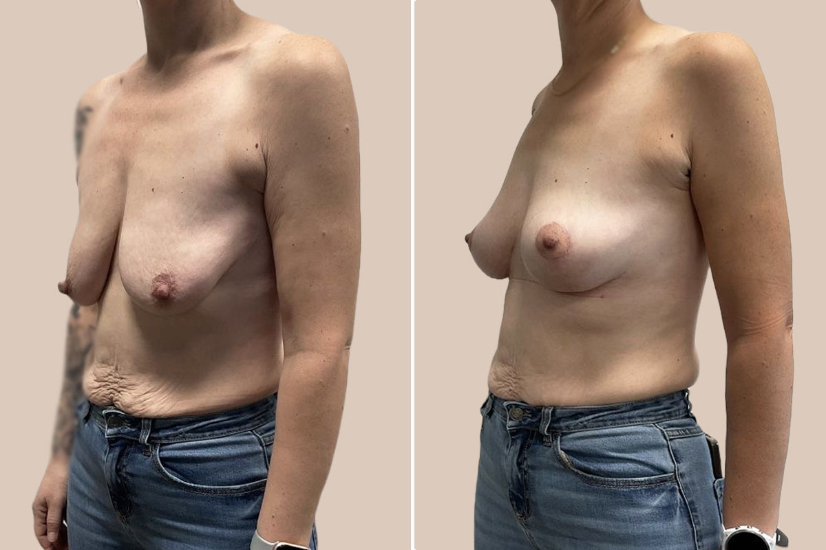 Stort brystløft før og efter