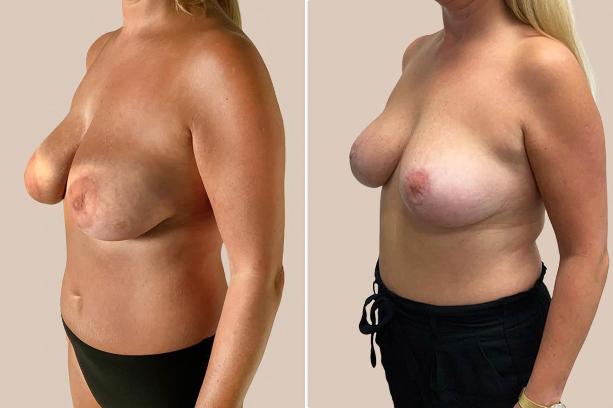 Brystreduktion før og efter