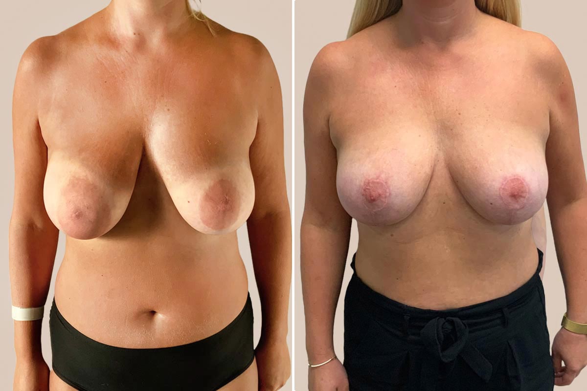 Brystreduktion før og efter