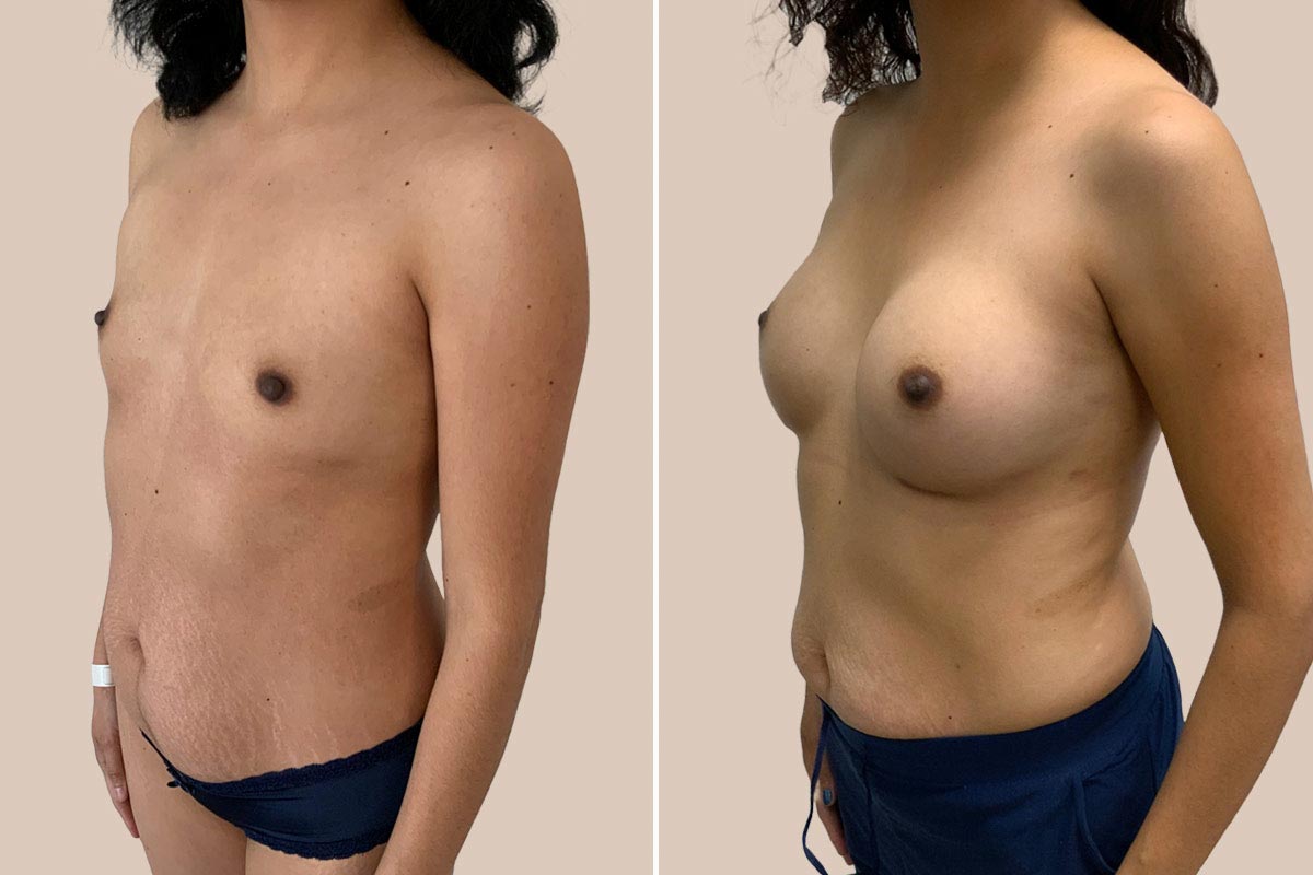 Brystforstørrelse før og efter