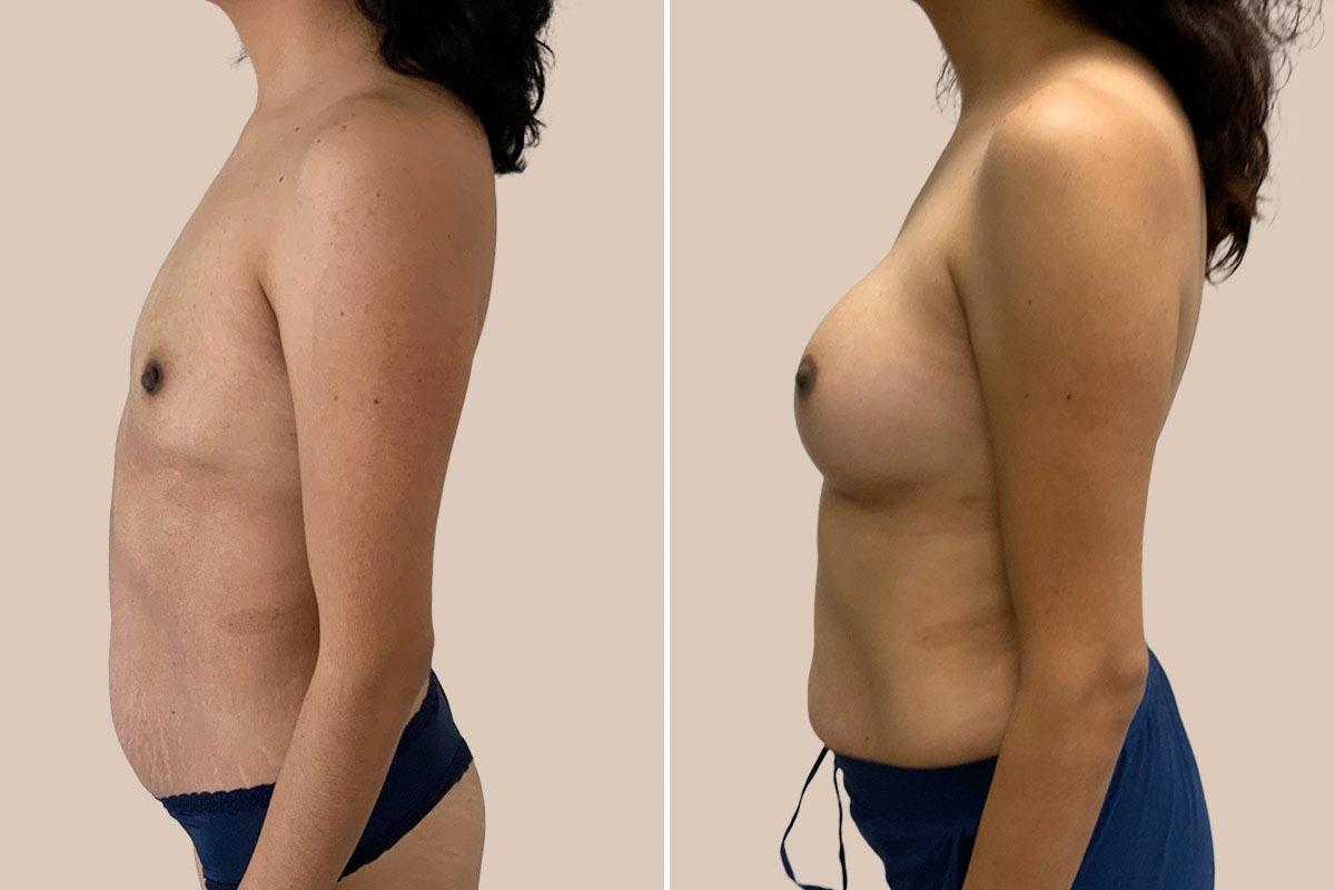 Brystforstørrelse før og efter