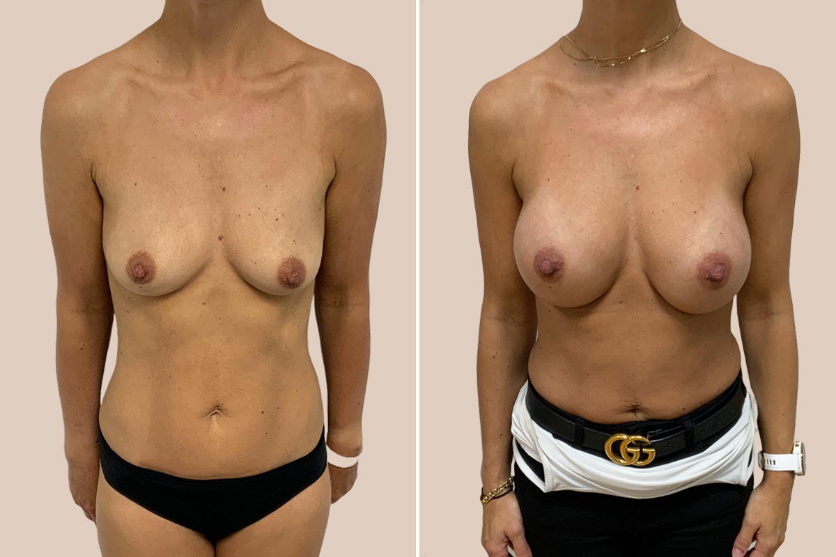 Brystforstørrelse før og efter