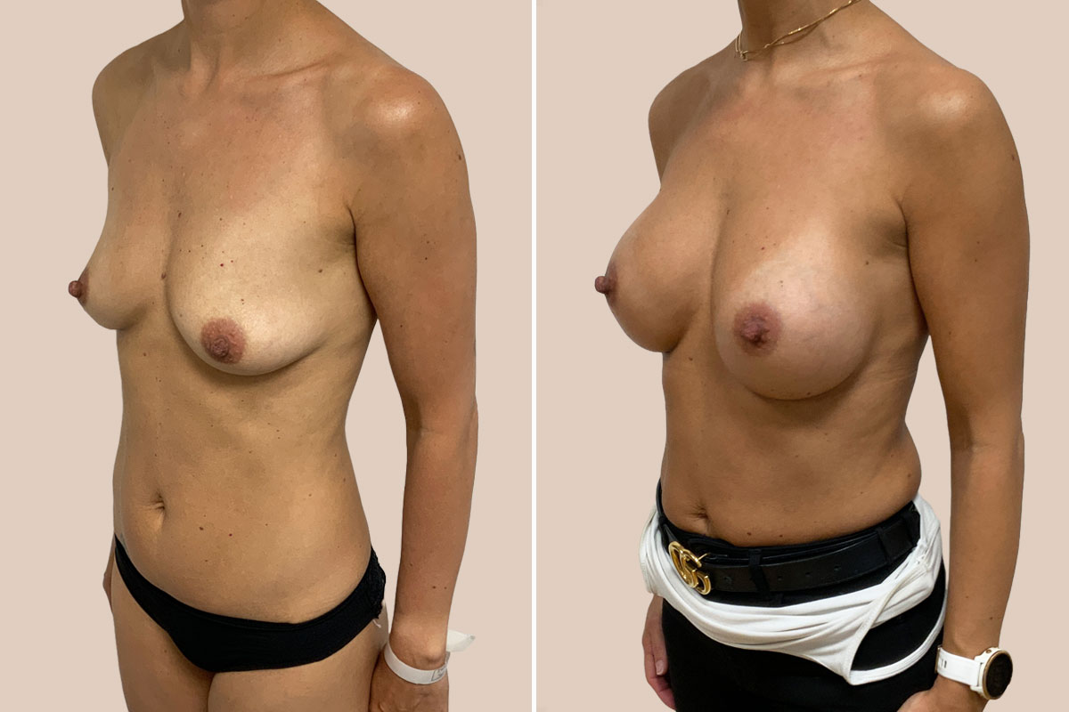Brystforstørrelse før og efter