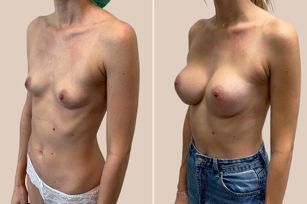 Brystforstørrelse før og efter