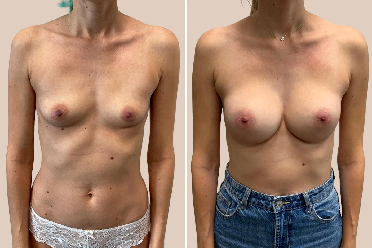 Brystforstørrelse før og efter