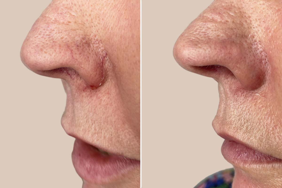 Karsprængninger, næsen