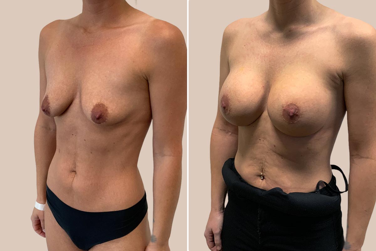 Brystforstørrelse og løft