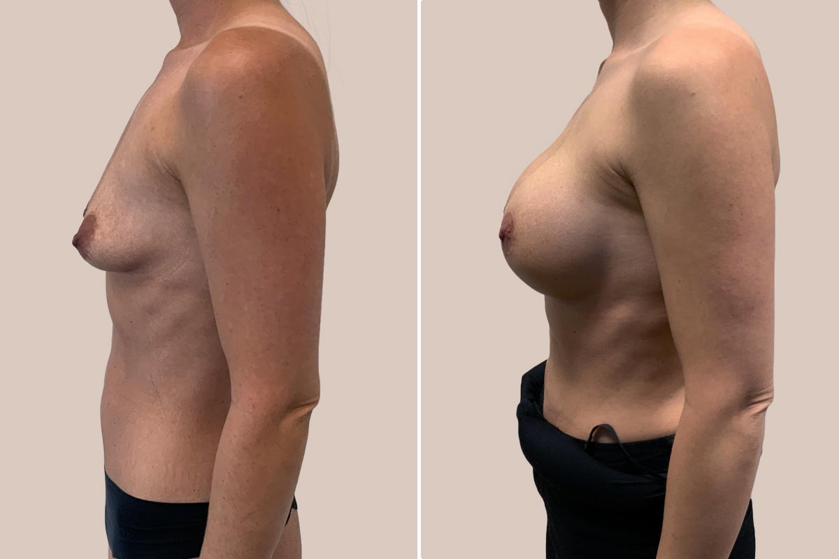 Brystforstørrelse og løft