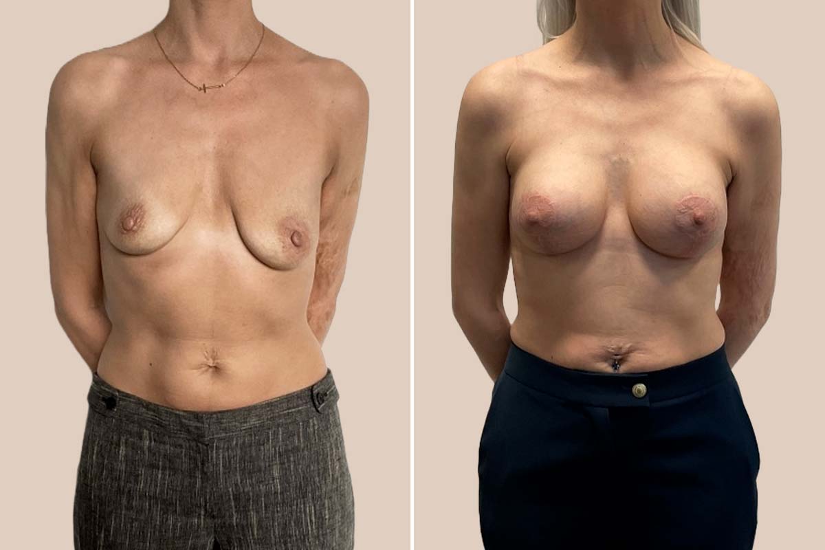 BFO + stort løft, før og efter