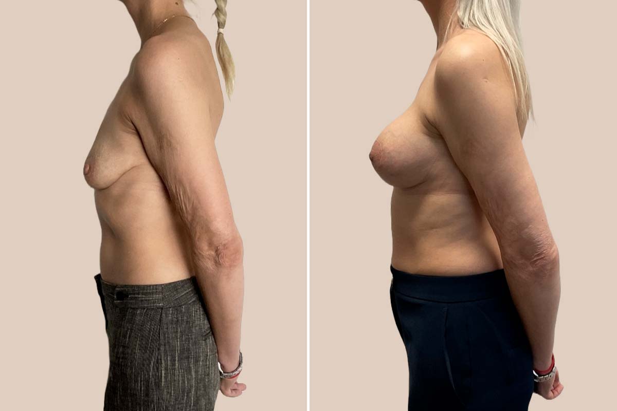 BFO + stort løft, før og efter