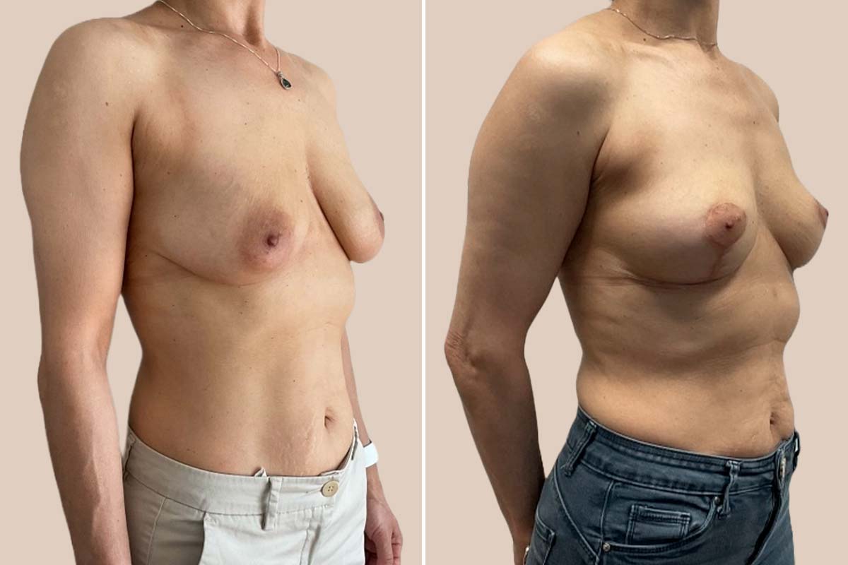 Stort brystløft før og efter