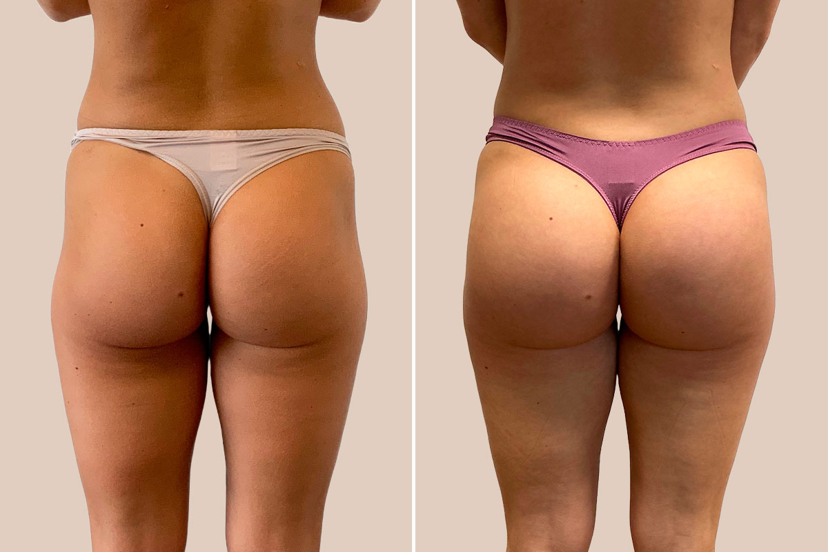 Baldeimplantater før og efter