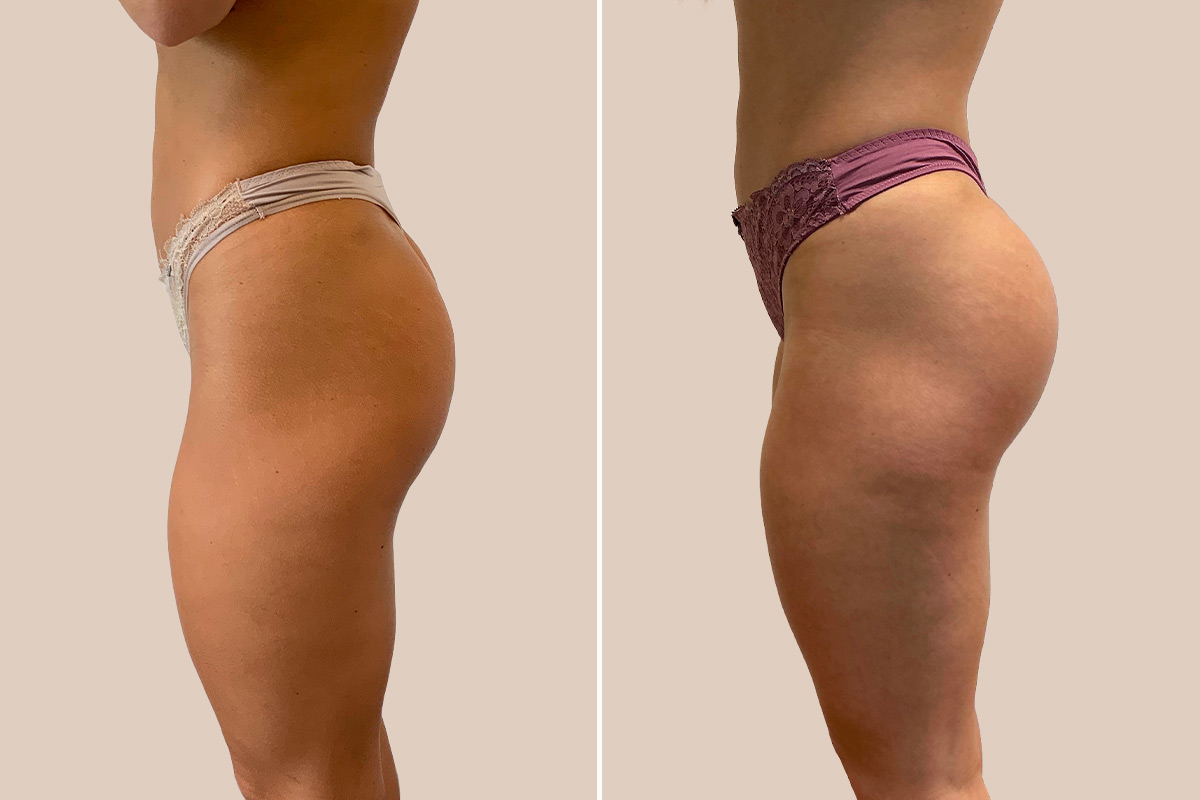 Baldeimplantater før og efter