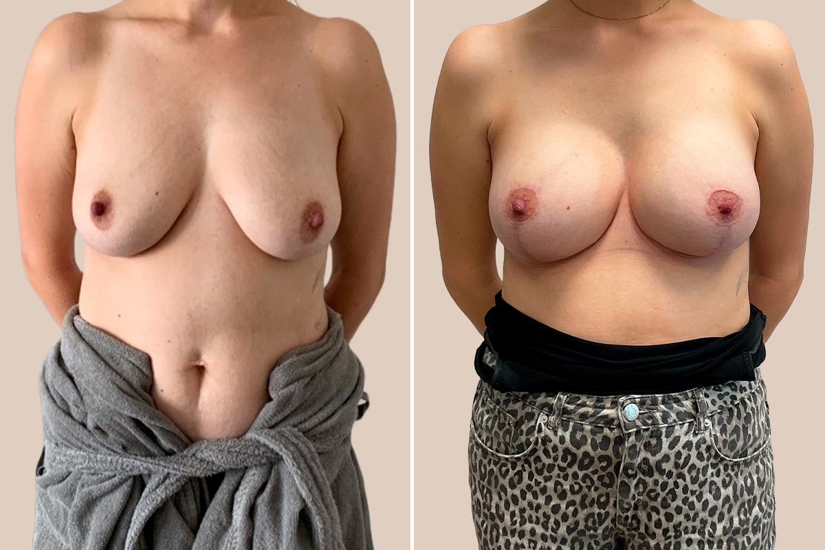 BFO + stort brystløft Før og efter