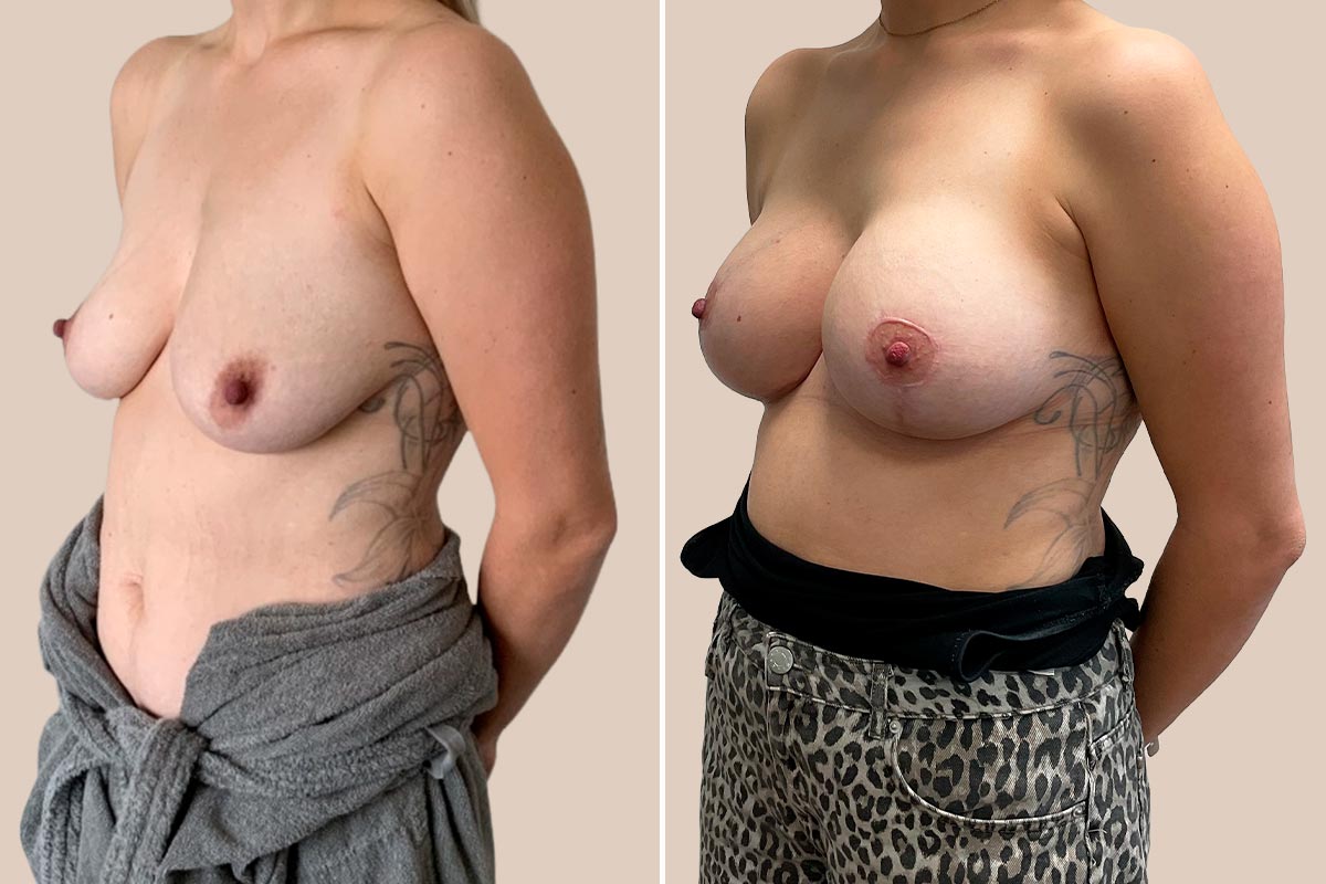 BFO + stort brystløft Før og efter