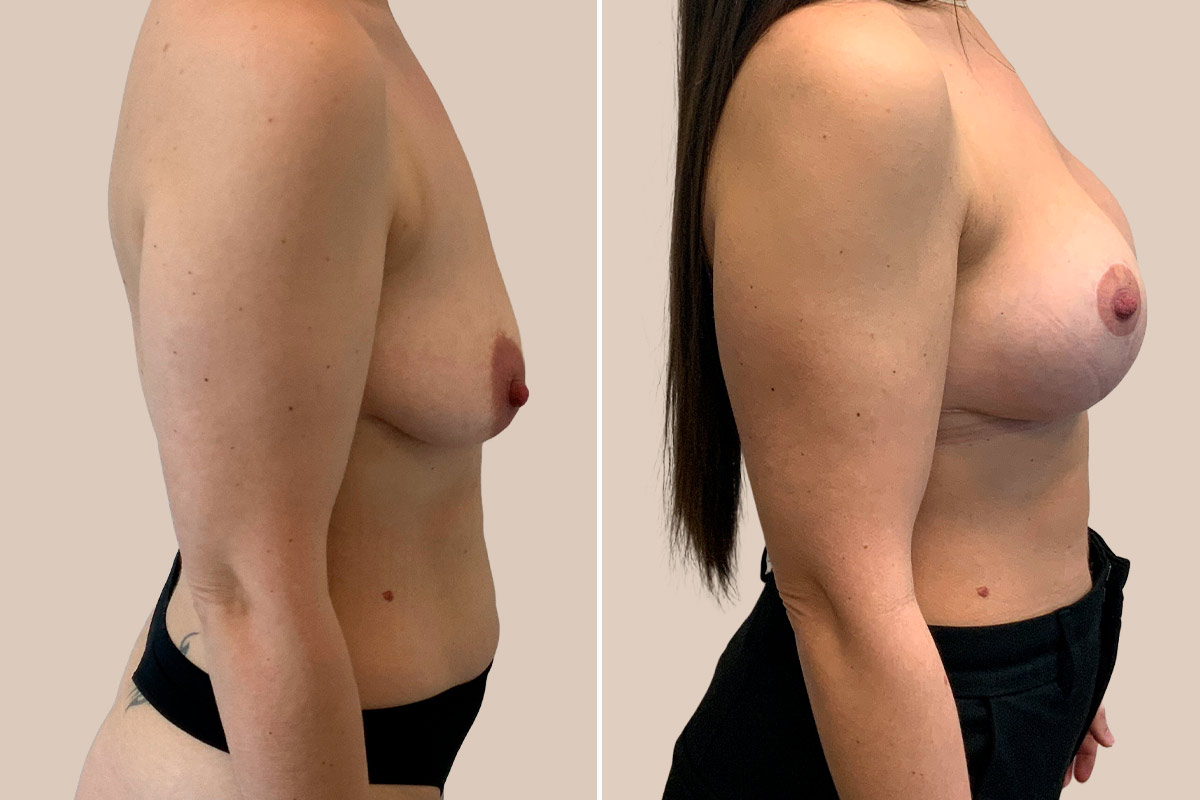 BFO + stort brystløft Før og efter